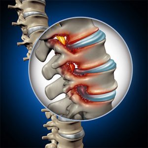 Symptoms of Spinal Stenosis Come on Gradually