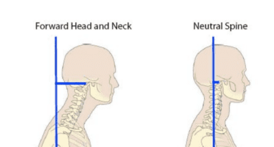 10 Ways to Help Prevent Forward Head Posture