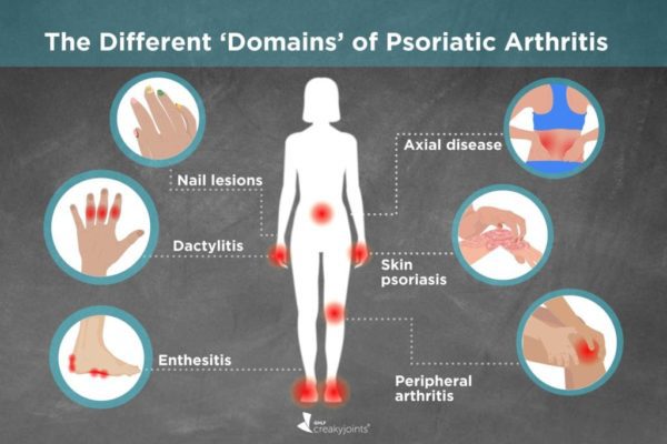 Symptoms and causes of psoriatic spondylitis