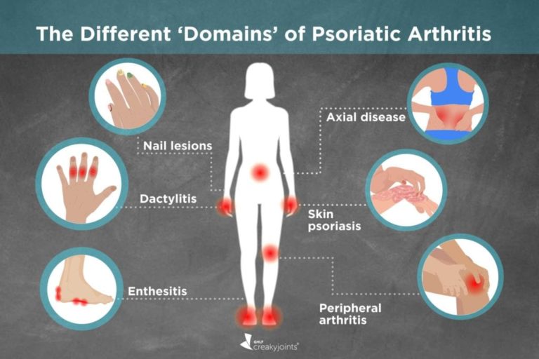 Treating Psoriatic Spondylitis to treat Psoriasis