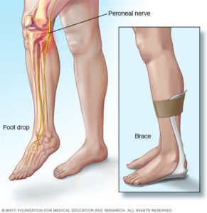 What's Causing Your High Steppage Gait? Symptom, Not Problem