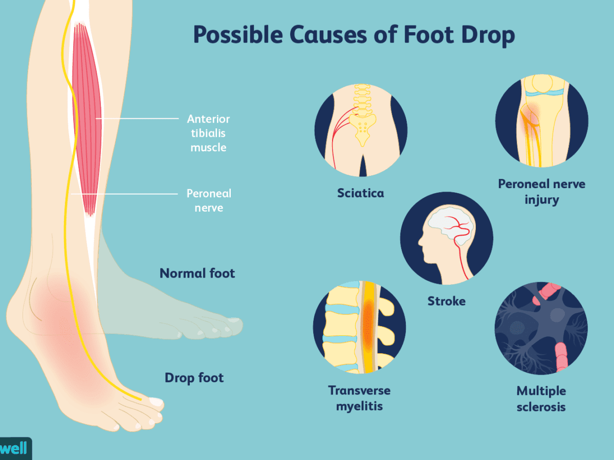 What's Causing Your High Steppage Gait? Symptom, Not Problem