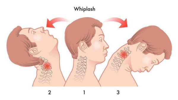 What-is-whiplash