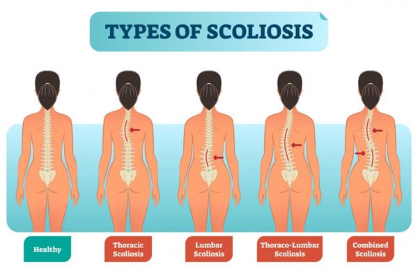 Symptoms Secondary to Scoliosis