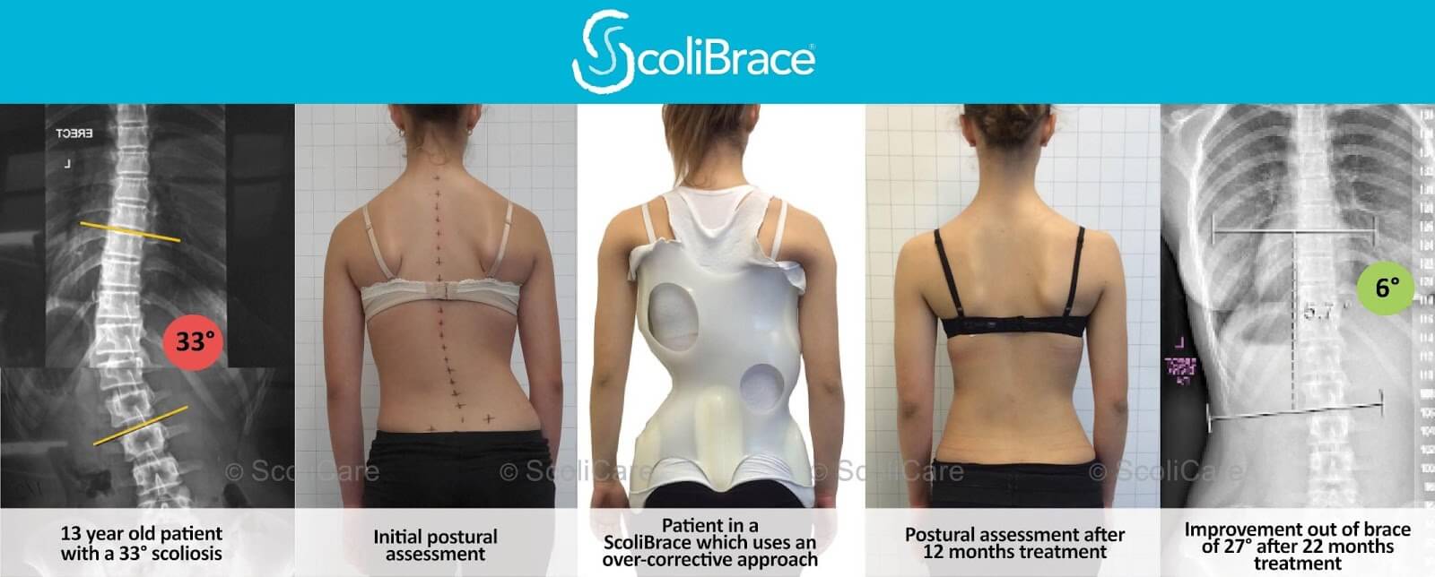 Brace related stress in scoliosis patients – Comparison of