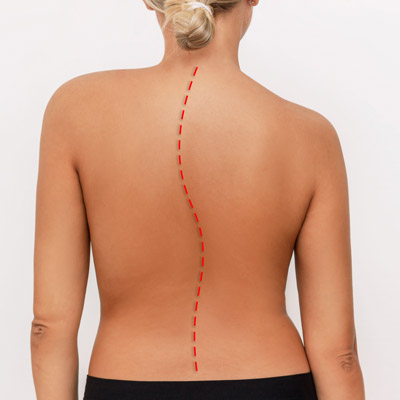 Is Scoliosis Genetic Is Scoliosis Genetic