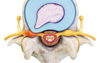 Spinal Stenosis Treatment