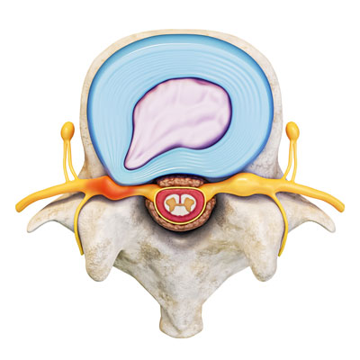 Spinal Stenosis Treatment