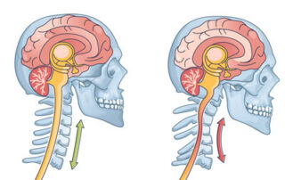 Cervical Kyphosis