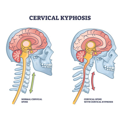 Cervical Kyphosis